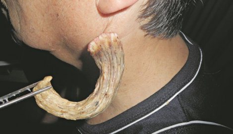 dr novak vukoje , tumor na vratu