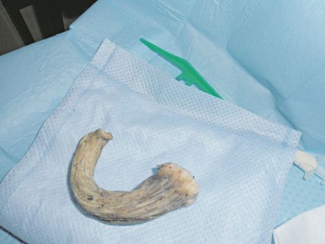dr novak vukoje , tumor na vratu