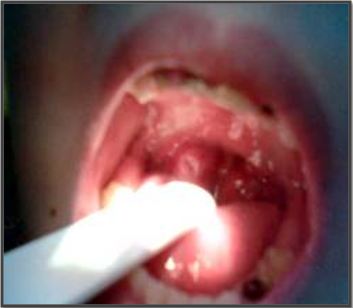 Lečenje hrkanja i slip apnea kod dece, Dr. Vukoje, Novi Sad