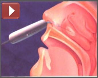 metode uvulopalatofaringoplastika