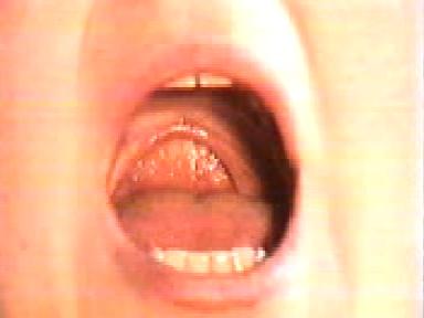 metode uvulopalatofaringoplastika