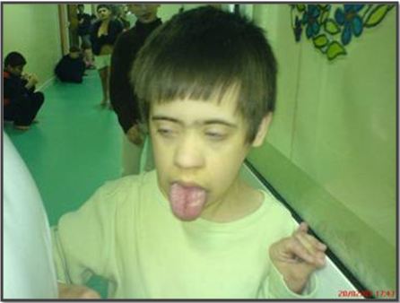 Lečenje hrkanja i slip apnea kod dece, Dr. Vukoje, Novi Sad