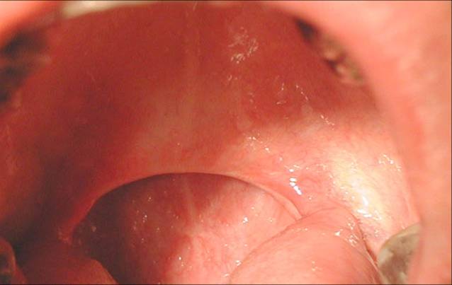 metode uvulopalatofaringoplastika