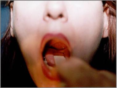 metode uvulopalatofaringoplastika