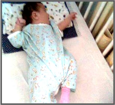 metode uvulopalatofaringoplastika